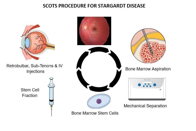 Graphic Stargardt Disease